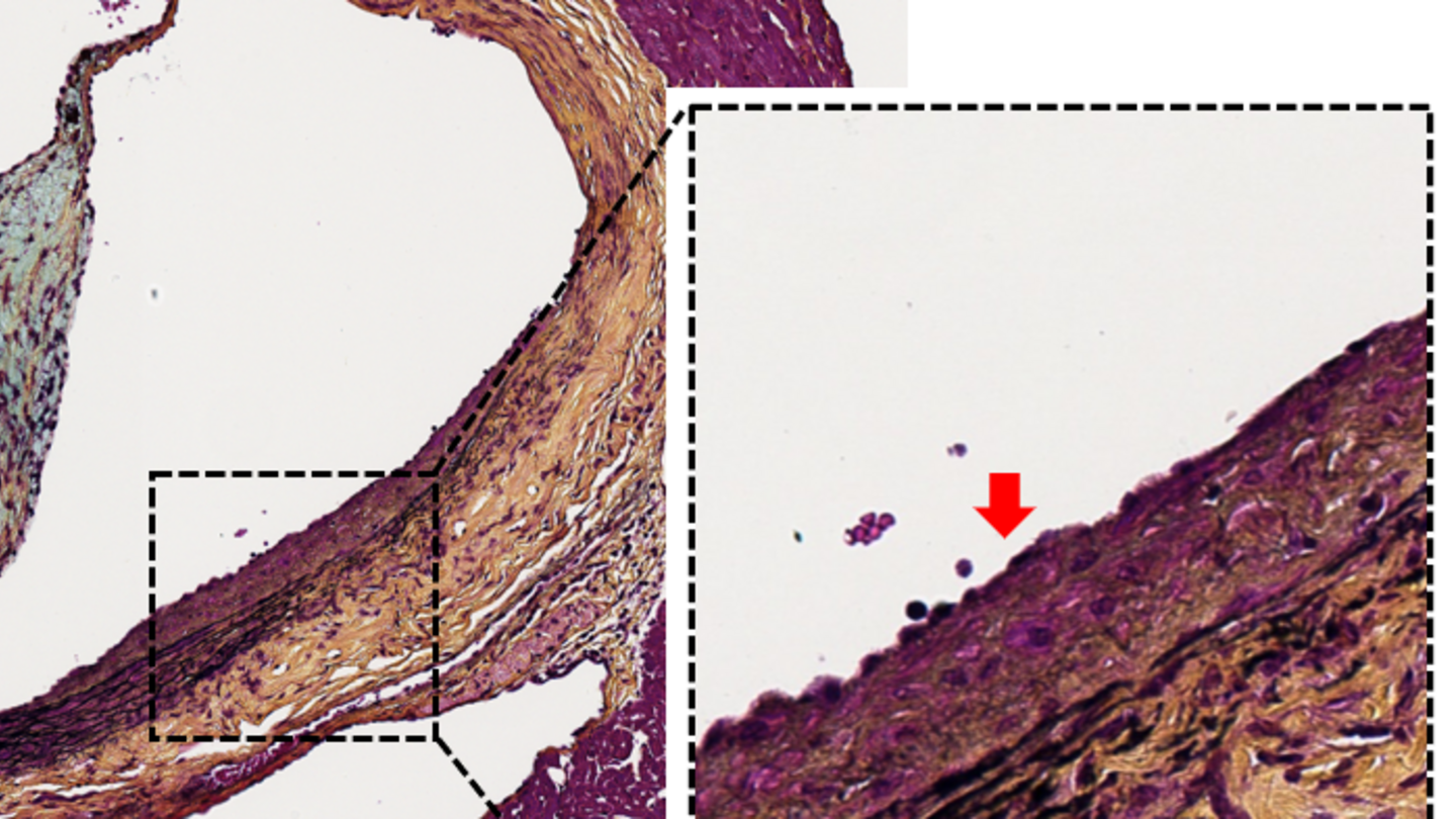 An aorta that has lost the ability to protect itself, with neointimal hyperplasia and medial degeneration, a thickening and deterioration of the blood vessel walls.