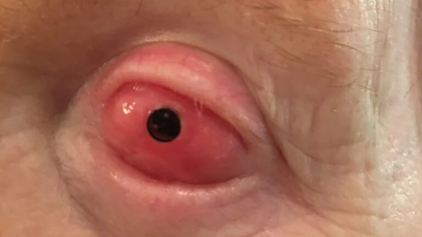 An eye that has received tooth-in-eye surgery
